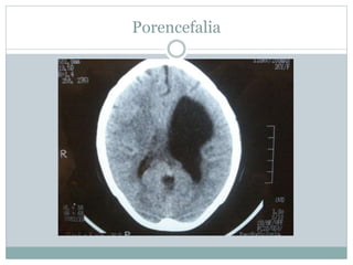 Porencefalia
 