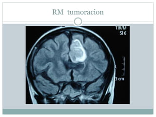 RM tumoracion
 