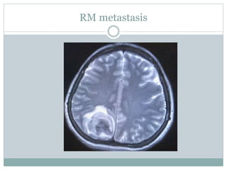 RM metastasis
 