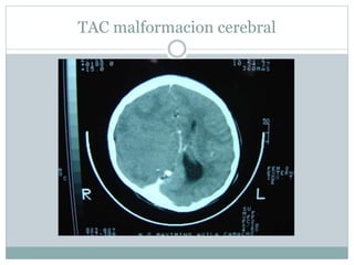 TAC malformacion cerebral
 