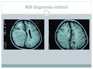 RM disgenesia cortical
 
