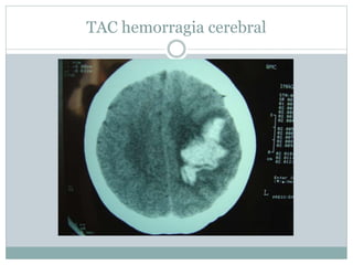 TAC hemorragia cerebral
 