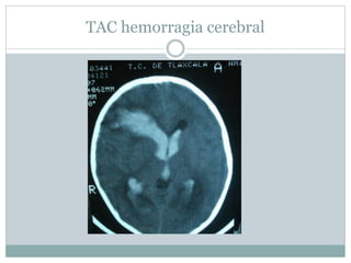 TAC hemorragia cerebral
 