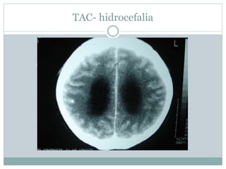 TAC- hidrocefalia
 