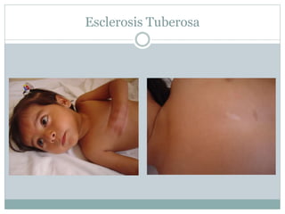 Esclerosis Tuberosa
 