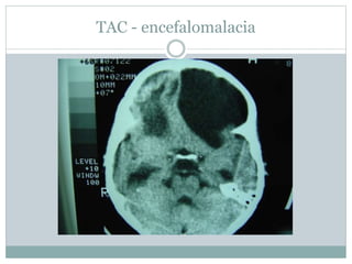TAC - encefalomalacia
 