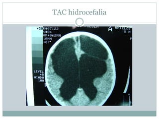 TAC hidrocefalia
 