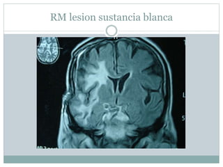RM lesion sustancia blanca
 