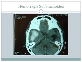 Hemorragia Subaracnoidea
 