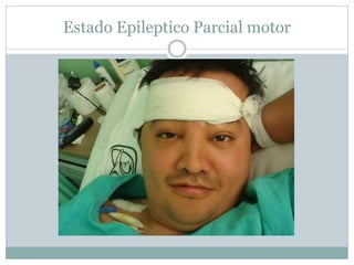 Estado Epileptico Parcial motor
 