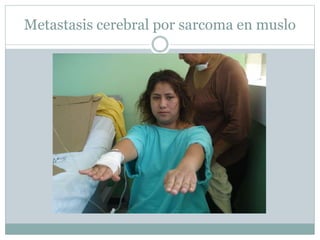 Metastasis cerebral por sarcoma en muslo
 