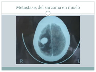 Metastasis del sarcoma en muslo
 