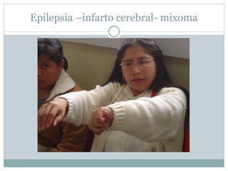 Epilepsia –infarto cerebral- mixoma
 