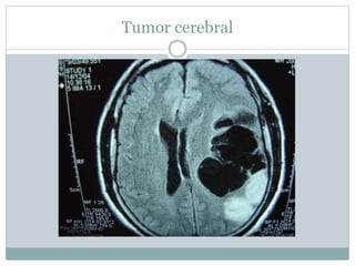 Tumor cerebral
 