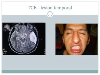 TCE –lesion temporal
 