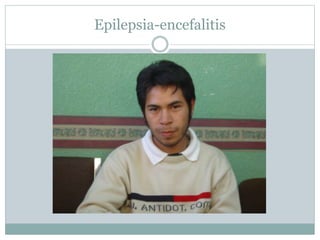 Epilepsia-encefalitis
 