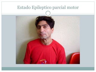 Estado Epileptico parcial motor
 