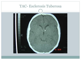 TAC- Esclerosis Tuberosa
 