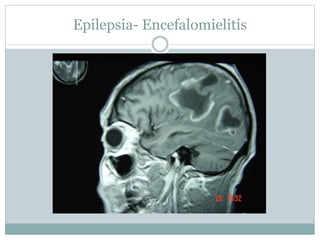 Epilepsia- Encefalomielitis
 