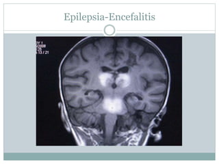 Epilepsia-Encefalitis
 