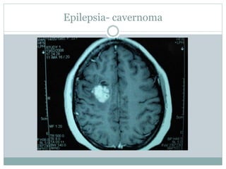 Epilepsia- cavernoma
 