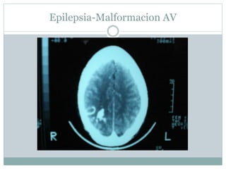 Epilepsia-Malformacion AV
 