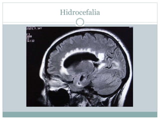 Hidrocefalia
 