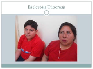 Esclerosis Tuberosa
 