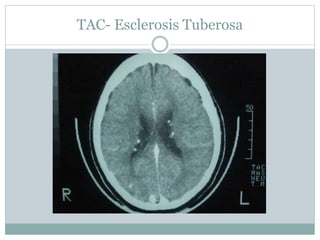 TAC- Esclerosis Tuberosa
 