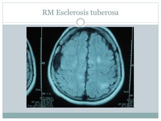 RM Esclerosis tuberosa
 