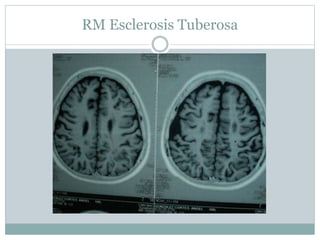RM Esclerosis Tuberosa
 