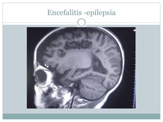 Encefalitis -epilepsia
 