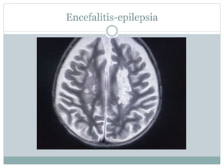 Encefalitis-epilepsia
 