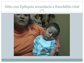 Niño con Epilepsia secundaria a Encefalitis viral
 