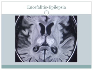 Encefalitis-Epilepsia
 