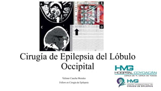 Cirugía de Epilepsia del Lóbulo
Occipital
Yelimer Caucha Morales
Fellow en Cirugía de Epilepsia
 