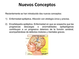 Nuevos Conceptos
Recientemente se han introducido dos nuevos conceptos:
1) Enfermedad epiléptica. Afección con etiología única y precisa.
2) Encefalopatía epiléptica. Enfermedad en que se sospecha que las
progresivas descargas o anormalidades epileptógenas
contribuyen a un progresivo deterioro de la función cerebral,
acompañándose de defectos motores y mentales graves.
 