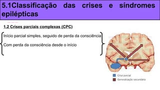 1.2 Crises parciais complexas (CPC)
Início parcial simples, seguido de perda da consciência
Com perda da consciência desde o início
5.1Classificação das crises e síndromes
epilépticas
 
