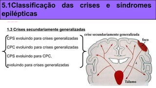 1.3 Crises secundariamente generalizadas
CPS evoluindo para crises generalizadas
CPC evoluindo para crises generalizadas
CPS evoluindo para CPC,
evoluindo para crises generalizadas
5.1Classificação das crises e síndromes
epilépticas
 