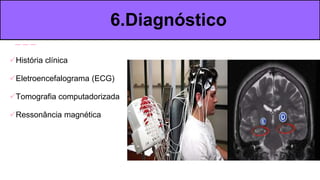 História clínica
Eletroencefalograma (ECG)
Tomografia computadorizada
Ressonância magnética
6.Diagnóstico
 