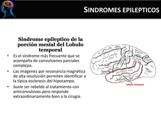 Sindrome epileptico de la
porción mesial del Lobulo
temporal
• Es el síndrome más frecuente que se
acompaña de convulsiones parciales
complejas.
• Las imágenes por resonancia magnética
de alta resolución permiten identificar a
la típica esclerosis del hipocampo.
• Suele ser rebelde al tratamiento con
anticonvulsivos pero responde
extraordinariamente bien a la cirugía.
SINDROMES EPILEPTICOS
 