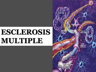 ESCLEROSIS
MULTIPLE
 