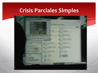 Crisis Parciales Simples
 
