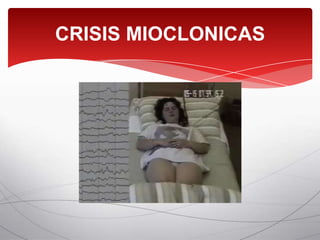 CRISIS MIOCLONICAS
 