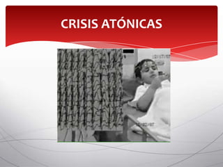 CRISIS ATÓNICAS
 