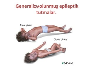 Generaliz olunmuş epileptikə
tutmalar.
 