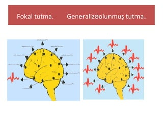 Fokal tutma. Generaliz olunmuş tutmaə .
 