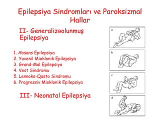 Epilepsiya Sindromları ve Paroksizmal
Hallar
II- Generaliz olunmuşə
Epilepsiya
1. Absans Epilepsiya
2. Yuvenil Mioklonik Epilepsiya
3. Grand-Mal Epilepsiya
4. Vest Sindromu
5. Lennoks-Qasto Sindromu
6. Progressiv Mioklonik Epilepsiya
III- Neonatal Epilepsiya
 