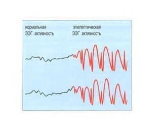 Epilepsiya yeni