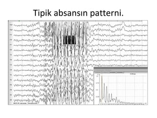 Tipik absansın patterni.
 